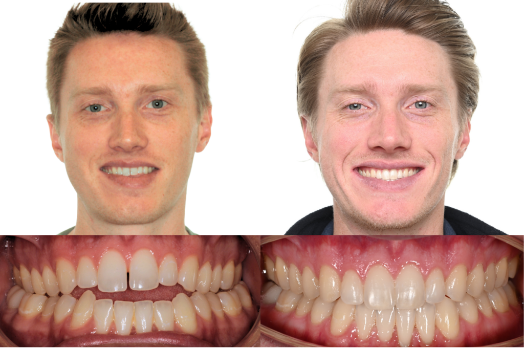 Zach Allen Pre and Post MARPE Utah