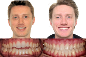 MARPE before and after skeletal expansion