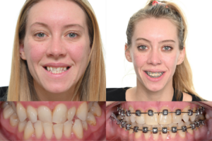 Palatal expansion before and after MARPE Utah