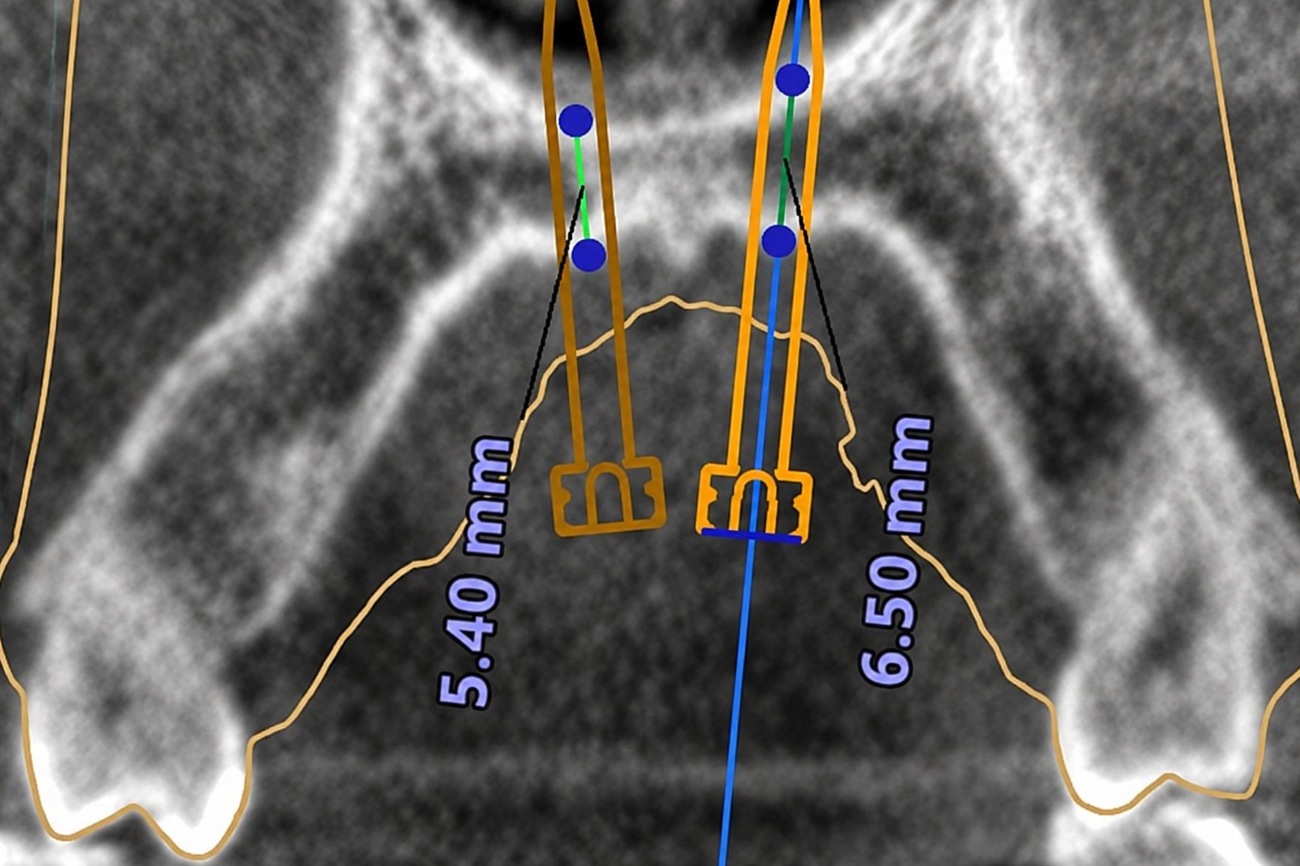 CBCT scan showing MARPE miniscrew depth measurements from the front view